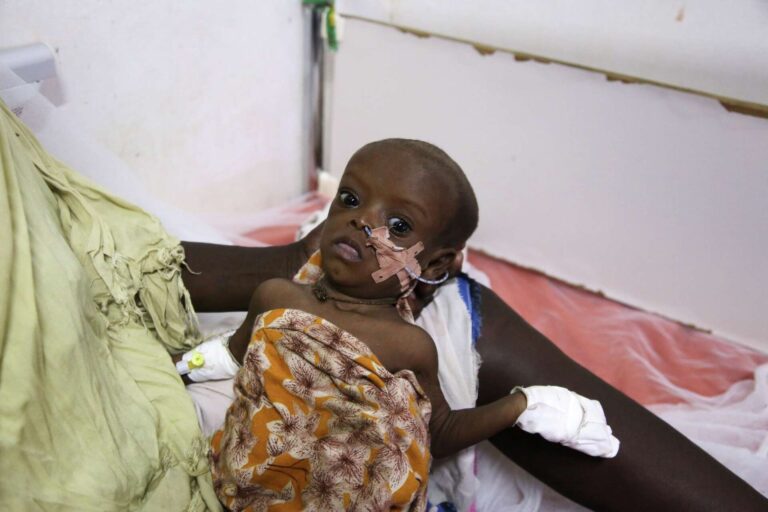 Nearly 1.92 Million Somali Children Face Acute Malnutrition Risks as Aid Shrinks.